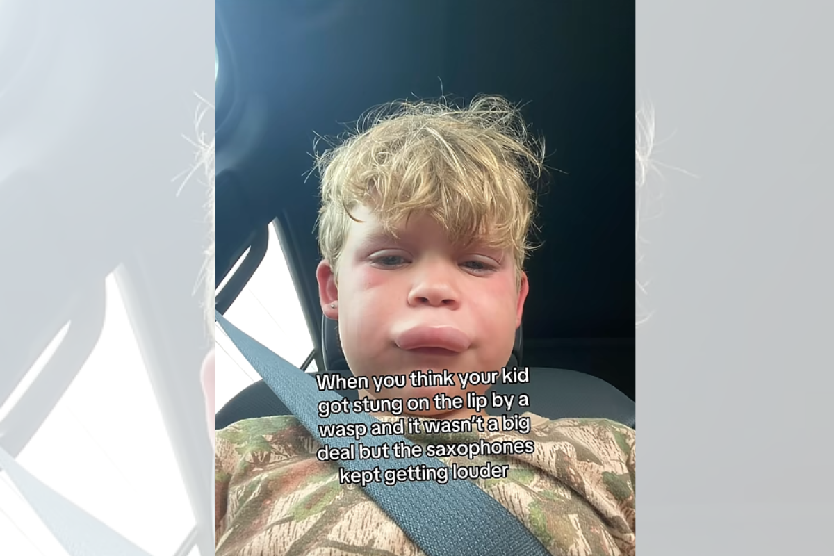 Menino é picado por vespa e reage com tranquilidade ao ver lábio inchado